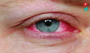 eye flue